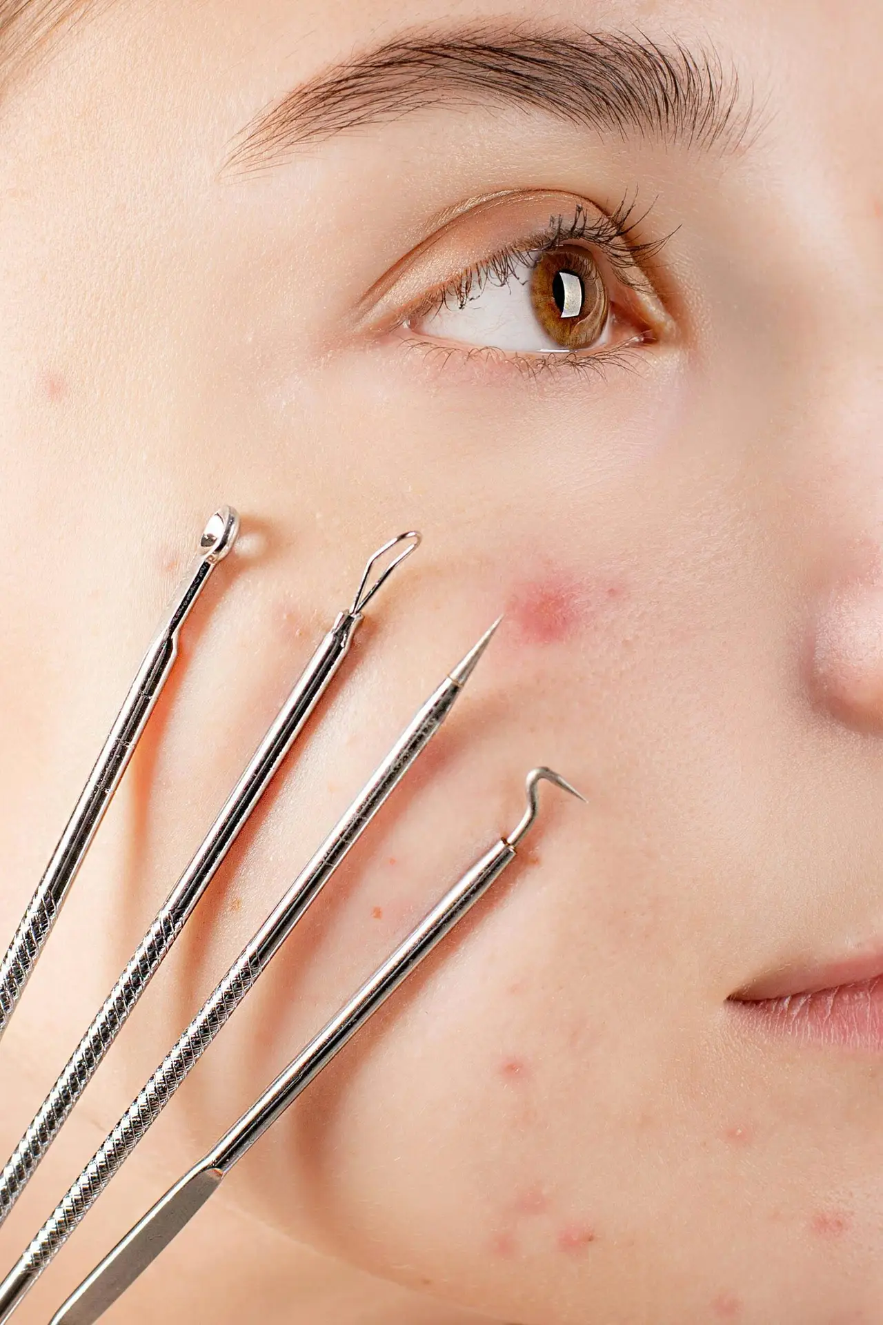 Big Blackheads Be Gone: A Dermatologist'S Proven Method - bne86ej
